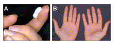 Fingertip unit corticosteroids