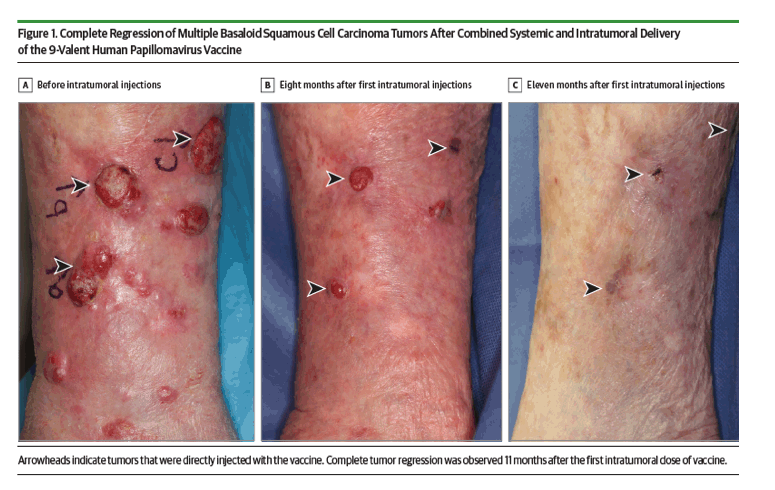 hpv vaccine skin cancer)